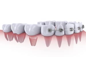 dental materials, dental restorations, braces, metal components, implant