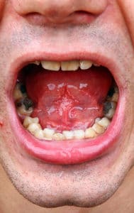 mouth, patient, dental mercury, amalgam fillings, silver fillings, teeth
