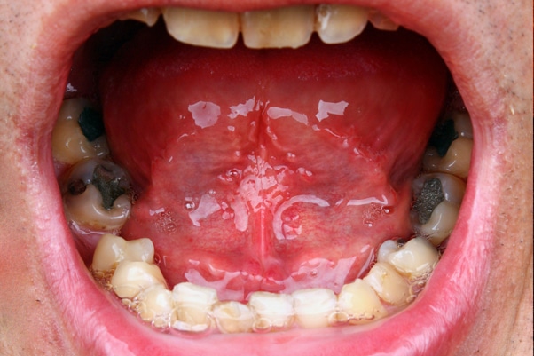 mouth, patient, dental mercury, amalgam fillings, silver fillings, teeth