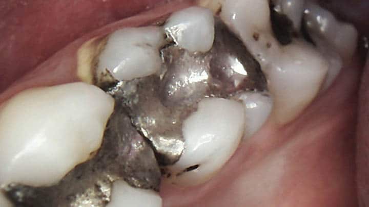 History and Regulations of the Dental Amalgam Controversy because of Mercury