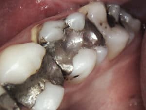 dental amalgam fillings