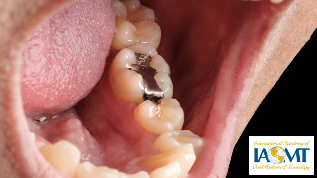amalgam in mouth2 The SMART Choice