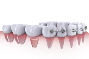 teeth with braces and dental implants